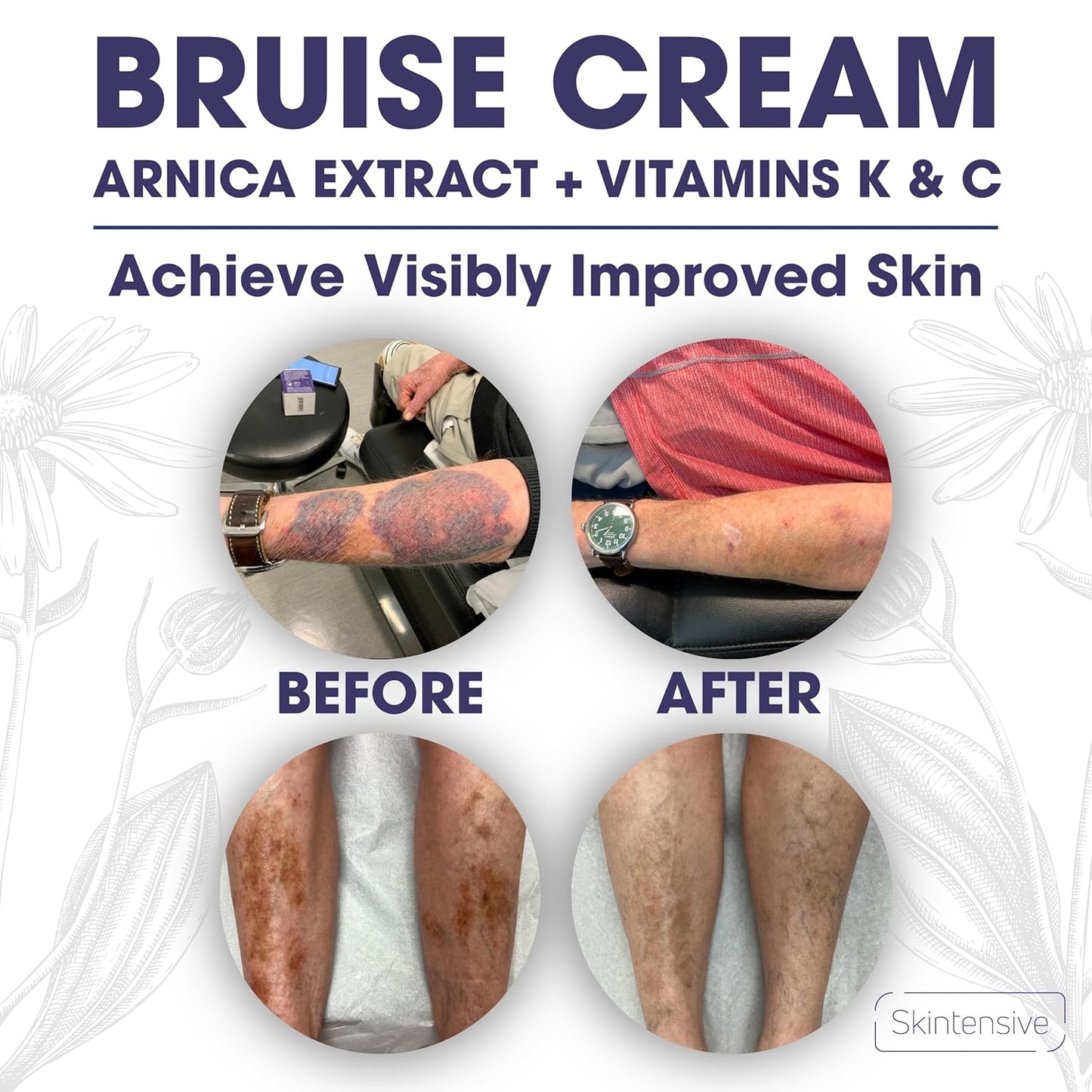 SKINTENSIVE Arnica Bruise Cream for Thin Skin – Vitamin K Cream for Bruises & Skin Discoloration, Moisturizing Arnica Cream for Seniors, Non-Greasy Formula, 4 Oz
